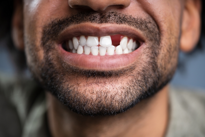 7 Best Options to Replace Missing Teeth or Damaged Teeth