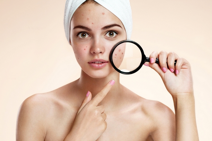 How to Get Rid of Acne Quickly and Easily